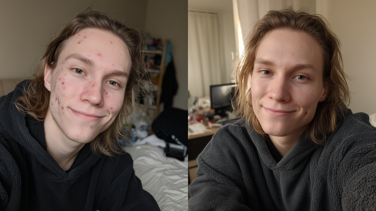 Qual é a melhor fronha para quem tem acne e pele sensível?